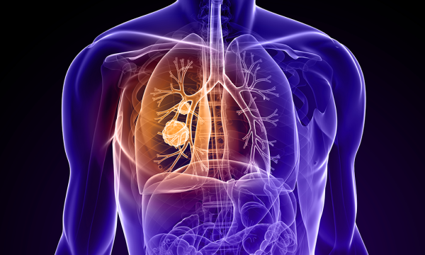 Lung cancer is one of the leading causes of cancer death in the United States. Fortunately, there have been rapid advancements in lung cancer treatment. 

- Creative Commons